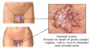 زگیل تناسلی چیست