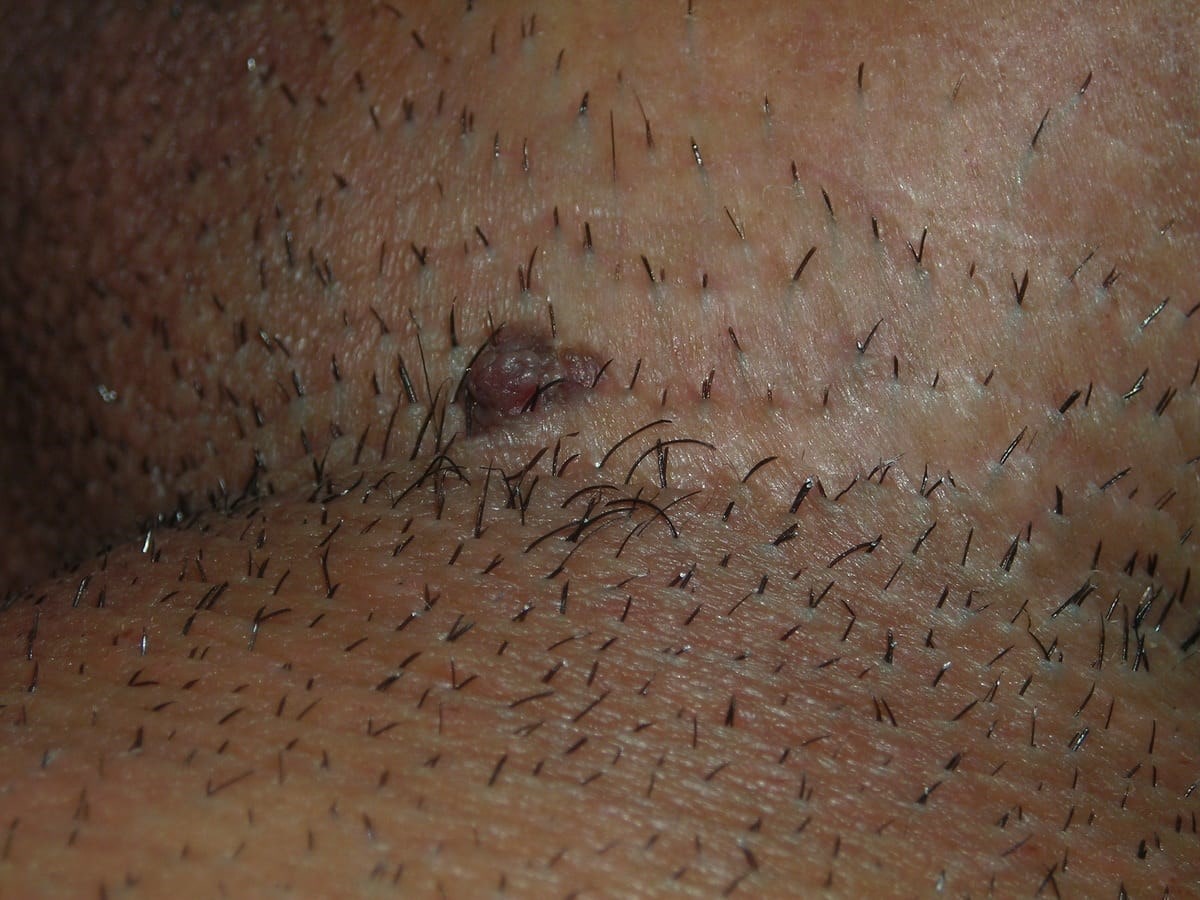 زگیل تناسلی چیست؟ 2 زگیل تناسلی چیست