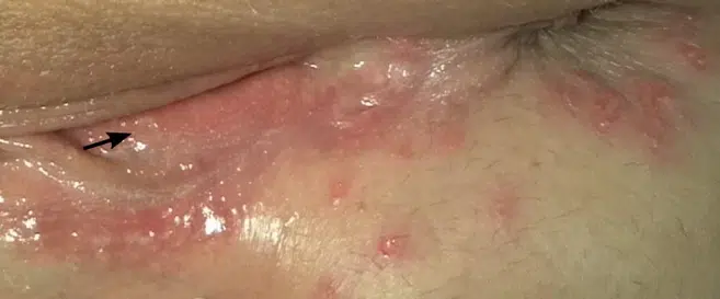 Herpes