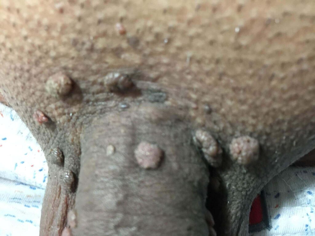 زگیل تناسلی چیست؟ 5 زگیل تناسلی چیست