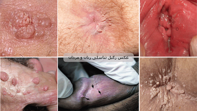 زگیل تناسلی چیست؟ 6 زگیل تناسلی
