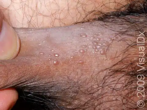 آیا درمان قطعی برای زگیل تناسلی یا HPV وجود دارد؟ 4 زگیل تناسلی چیست و ظاهر ضایعات