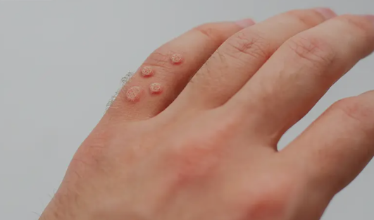 انواع تایپ های پر خطر و کم خطر HPV