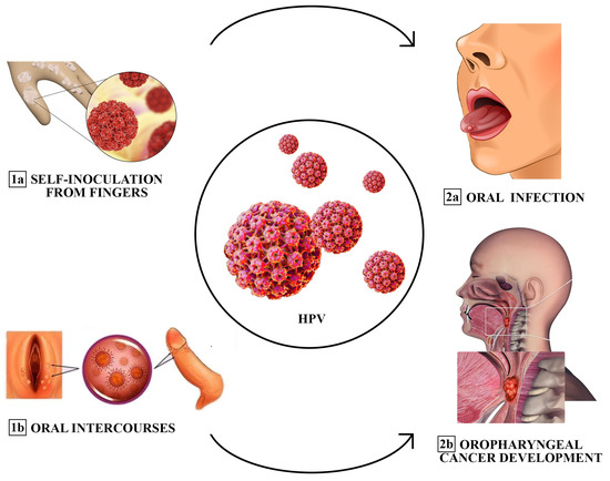 راه های انتقال تایپ 6 و 11 ویروس HPV