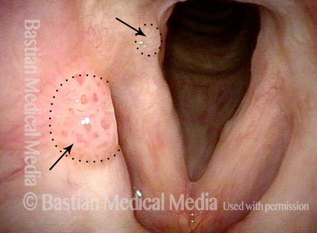 راهنمای تایپ 16 و 18 HPV تایپ 16 و 18 ویروس HPV