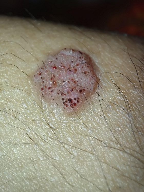 تایپ 16 و 18 ویروس HPV زگیل تناسلی