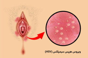 تفاوت تبخال HSV-1 و HSV-2