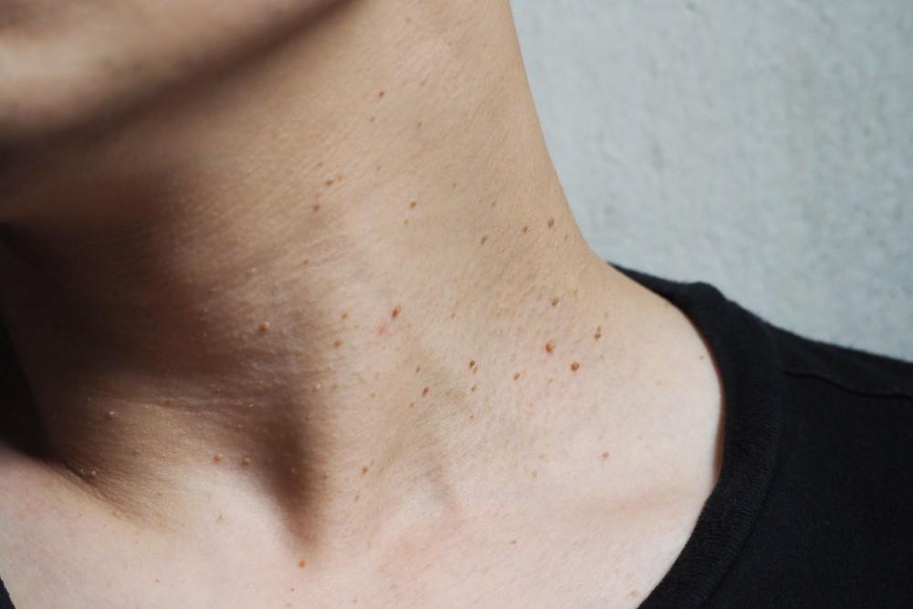  اسکین تگ و مقاومت به انسولین skin tag insulin resistance