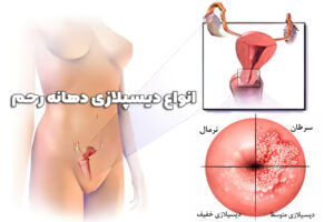 دیسپلازی دهانه رحم چیست؟