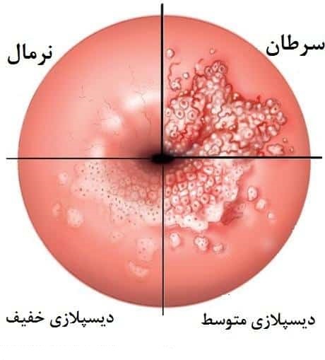 dysplasia