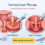 Cervical Laser Therapy